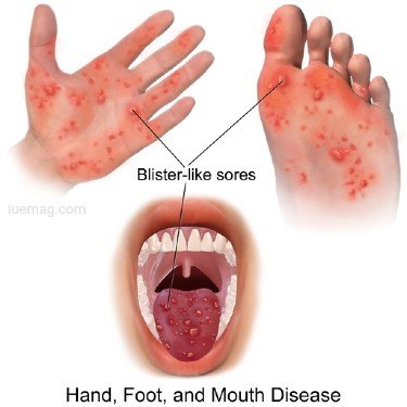 Hand Foot And Mouth
