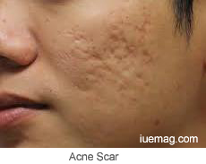 Acne scar, Acne mark
