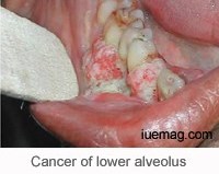Oral Cancers - Diagnosis and its Management