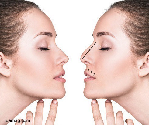 Rhinoplasty: Reshape your nose