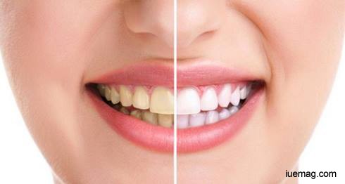 10 Reasons You Have Stained Teeth