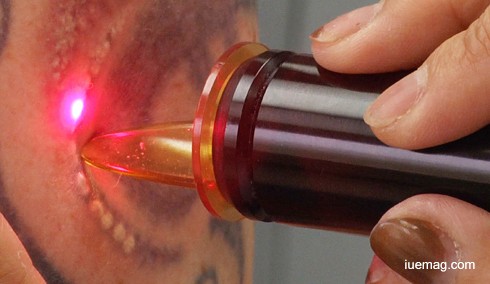Tattoo Removal: Laser Treatment