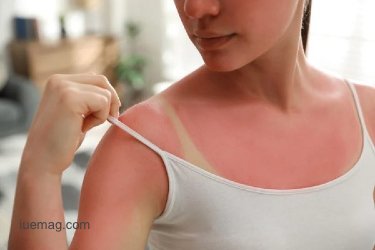10 Easy and Effective Home Remedies for Sunburn