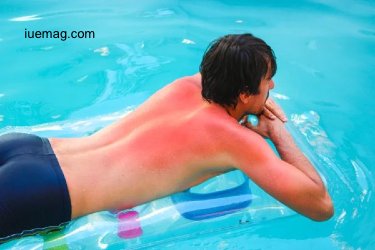 10 Easy and Effective Home Remedies for Sunburn
