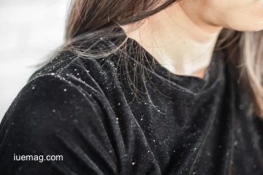 How to Get Rid of Dandruff Naturally