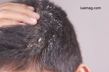 How to Get Rid of Dandruff Naturally