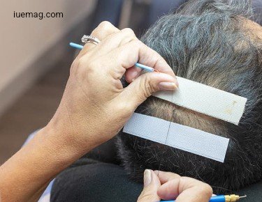 Repopulate Your Scalp Affected by Hair Loss