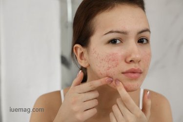 Suffering from Acne? These Remedies Can Help