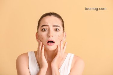 Suffering from Acne? These Remedies Can Help